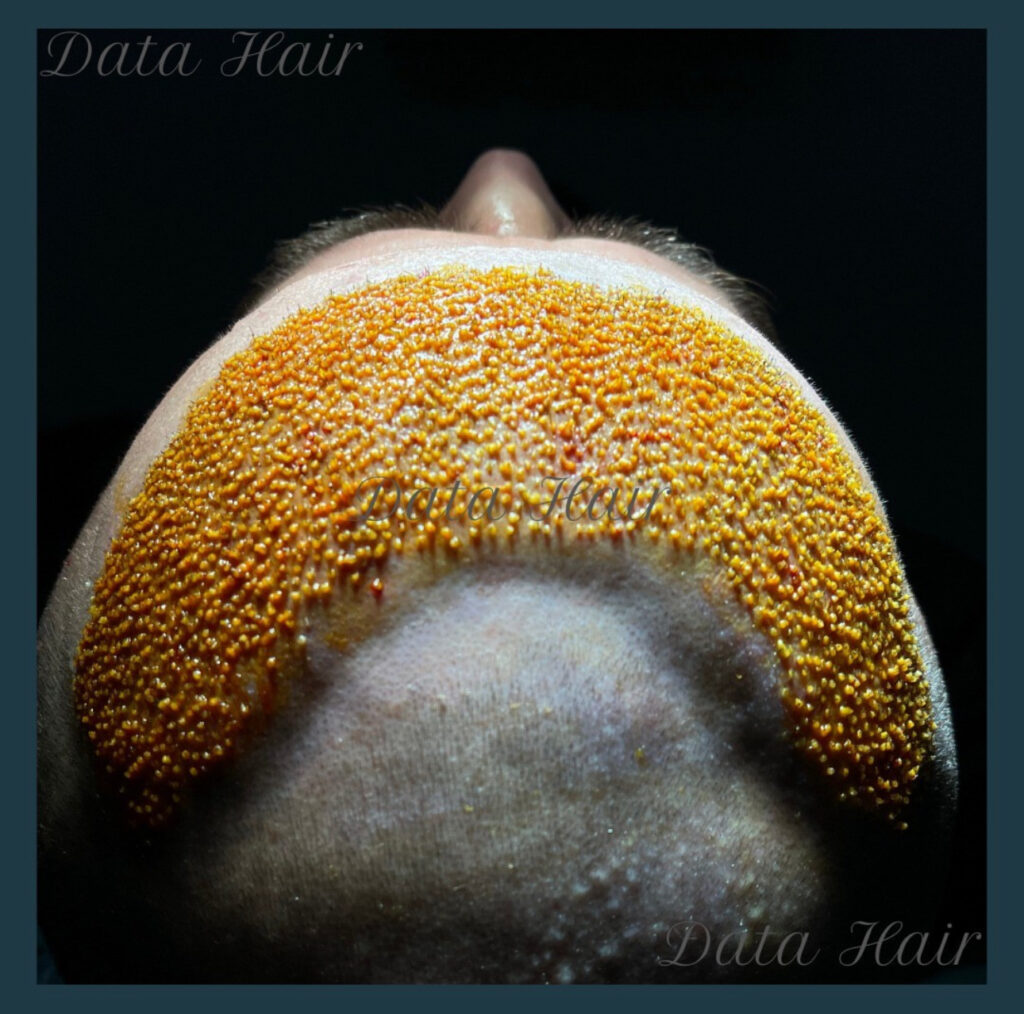 Data Hair Clinic & Eyyüp Tütüncü Saç Ekim Merkezi gallery photo