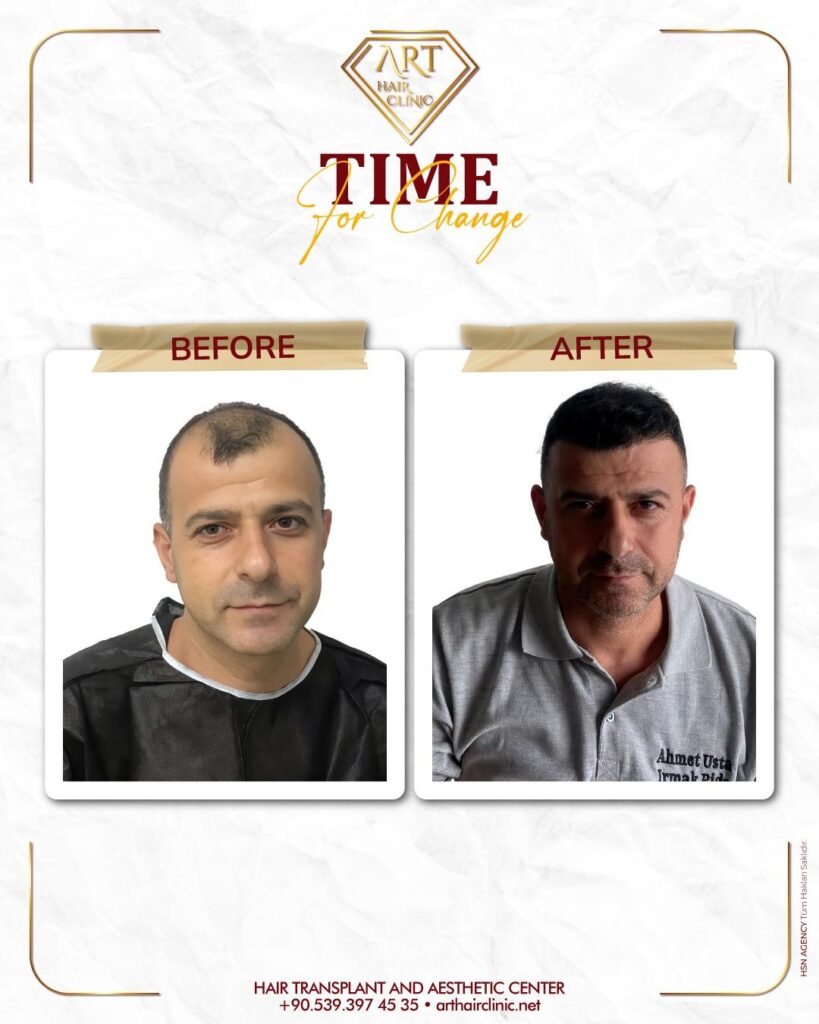 İzmir Saç Ekim Merkezi – Art Hair Clinic gallery photo