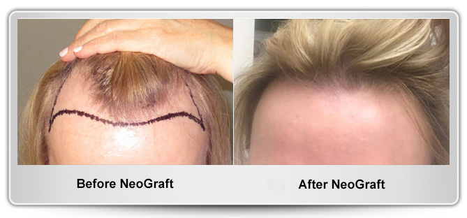 Maryland Hair Transplant gallery photo