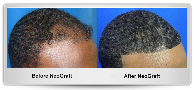 Maryland Hair Transplant gallery photo