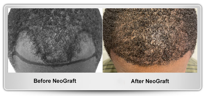 Maryland Hair Transplant gallery photo
