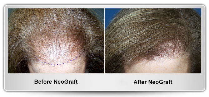 Maryland Hair Transplant gallery photo