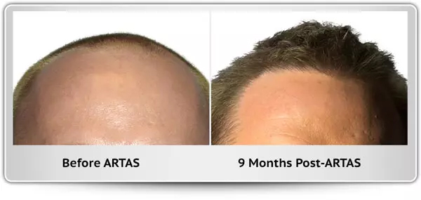 Maryland Hair Transplant gallery photo