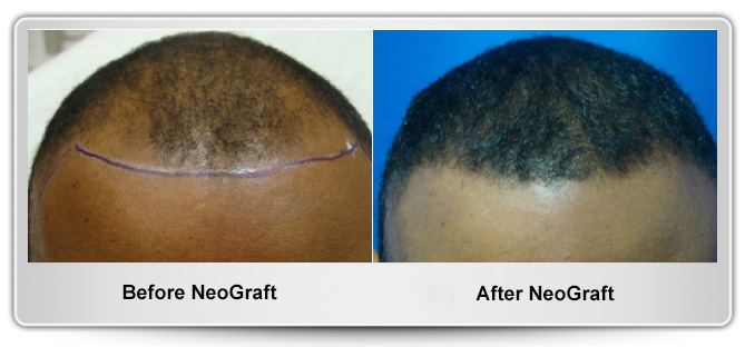 Maryland Hair Transplant gallery photo