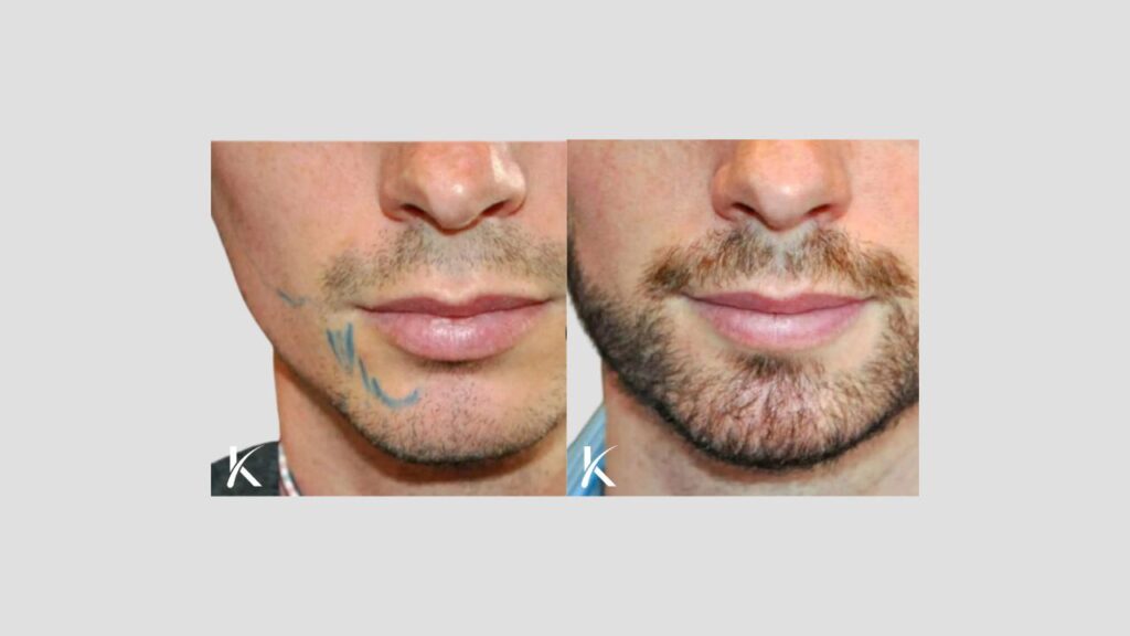 Kopelman Hair Restoration Boca Raton | Hair Transplant Clinic gallery photo