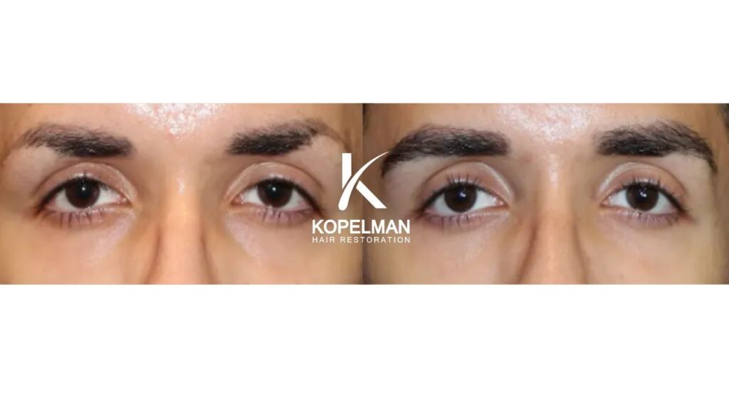 Kopelman Hair Restoration Boca Raton | Hair Transplant Clinic gallery photo