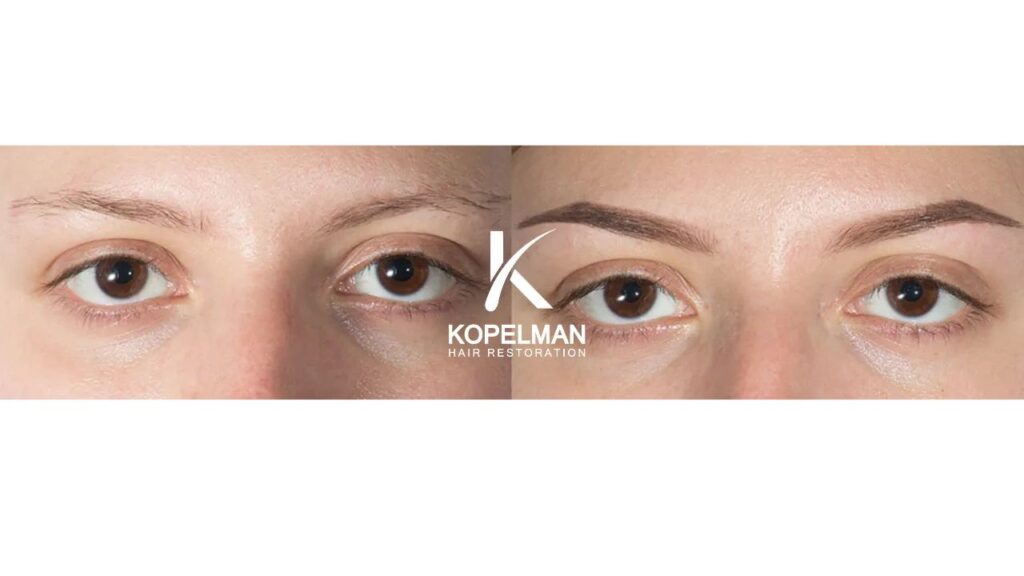 Kopelman Hair Restoration Boca Raton | Hair Transplant Clinic gallery photo