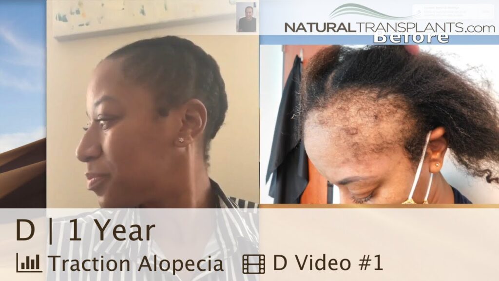 Natural Transplants, Hair Restoration Clinic gallery photo