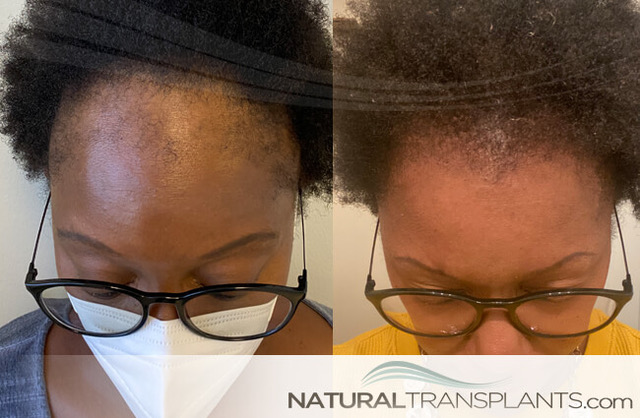 Natural Transplants, Hair Restoration Clinic gallery photo