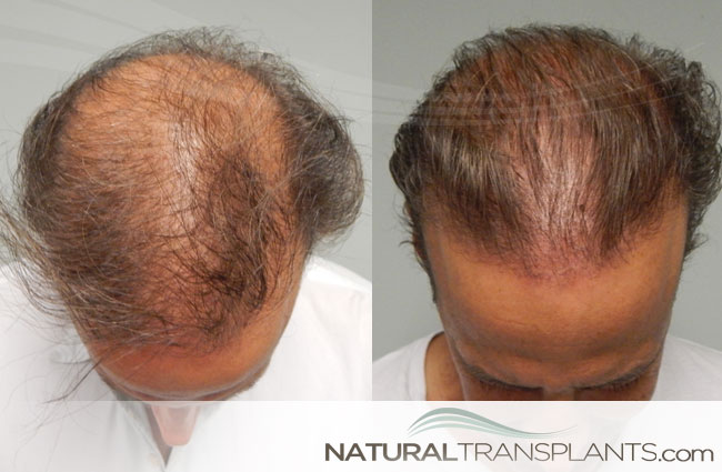 Natural Transplants, Hair Restoration Clinic gallery photo