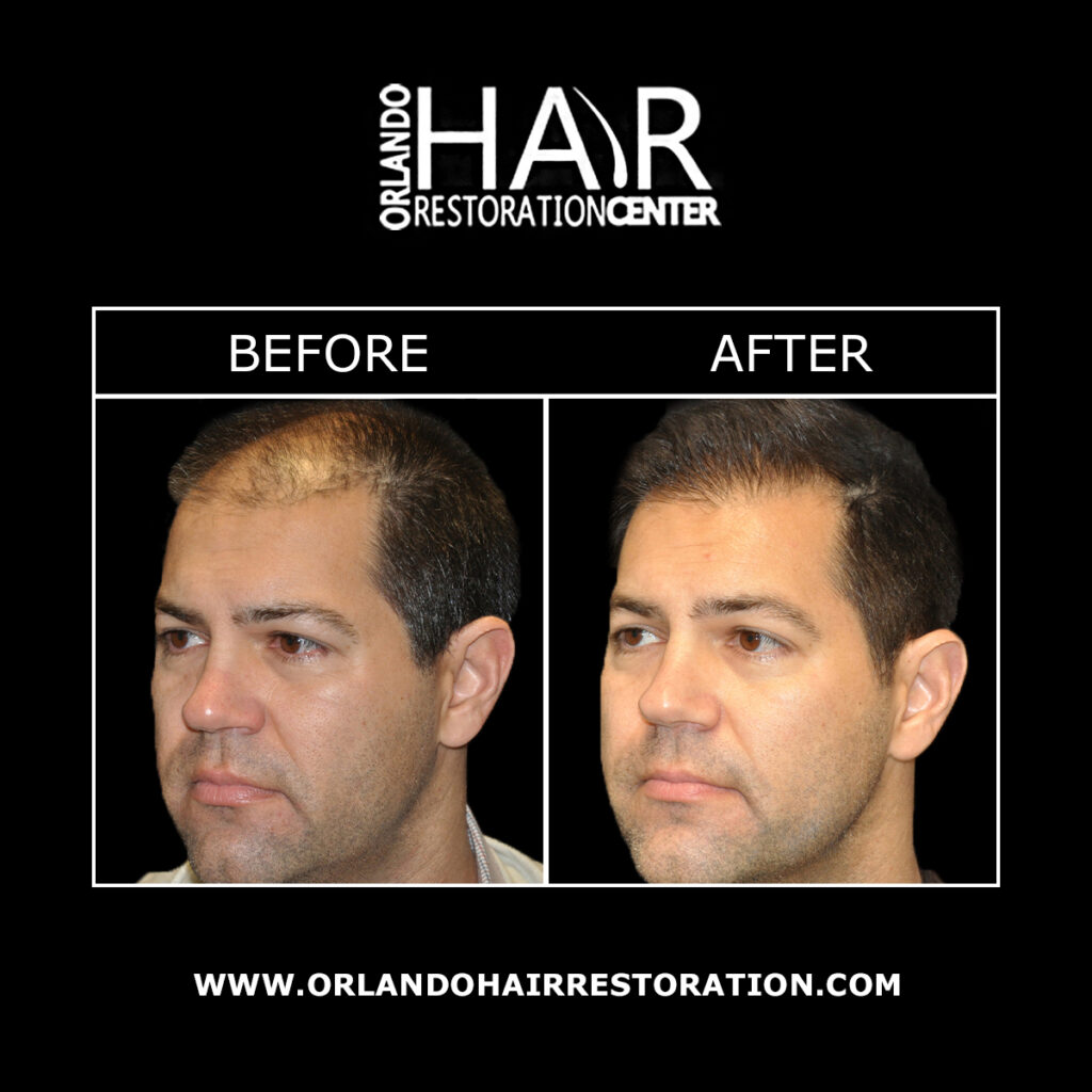 Orlando Hair Restoration Center gallery photo