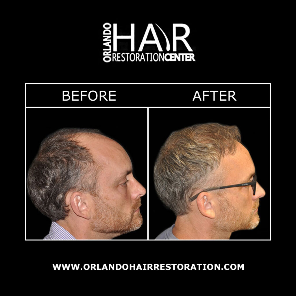 Orlando Hair Restoration Center gallery photo