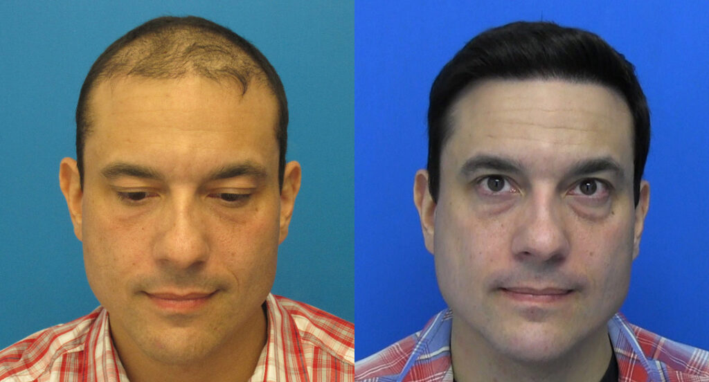 Hasson & Wong Hair Transplant Clinic Seattle gallery photo