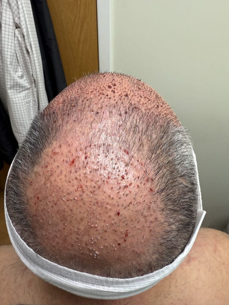 Oak Brook Hair Transplant gallery photo