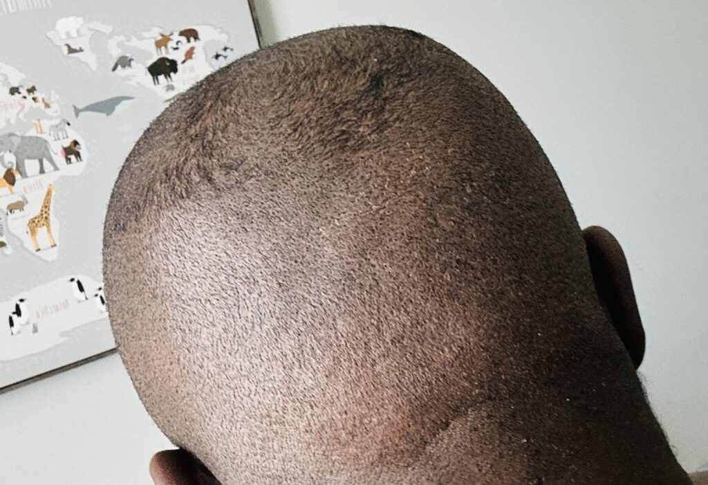 Oak Brook Hair Transplant gallery photo