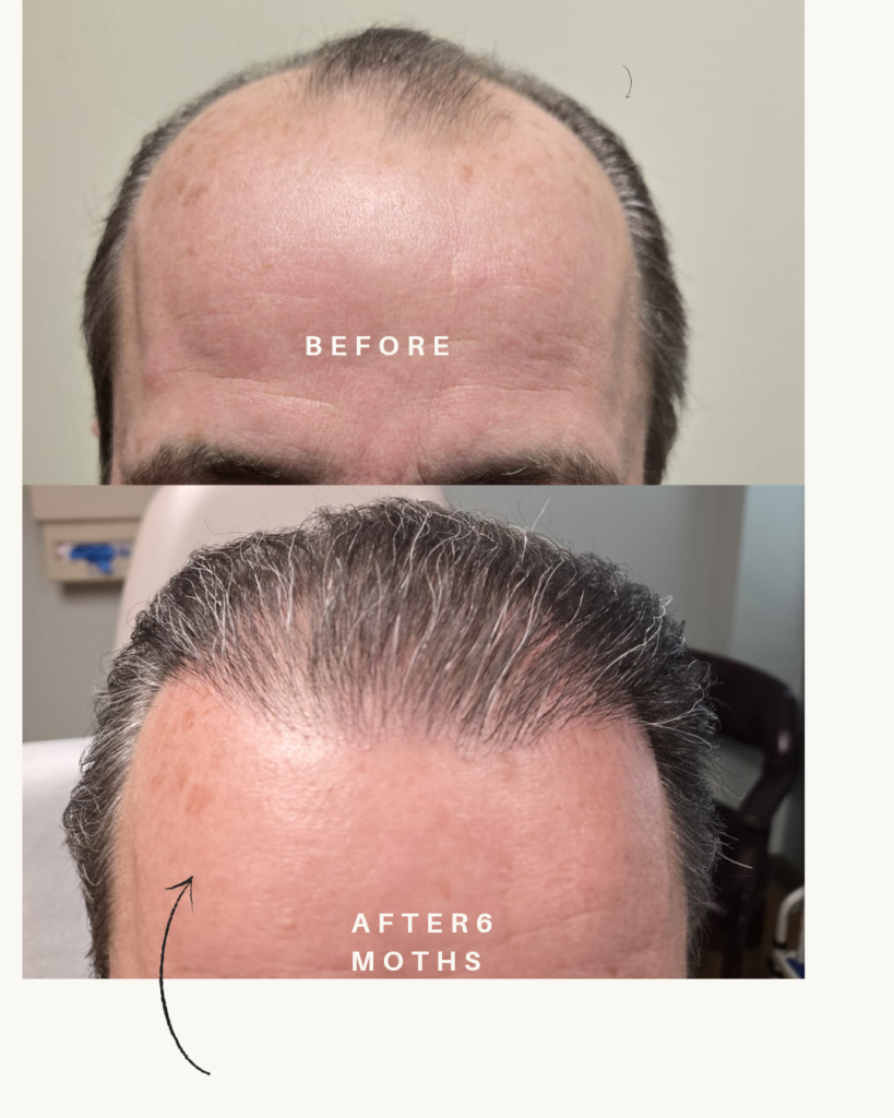 Oak Brook Hair Transplant gallery photo