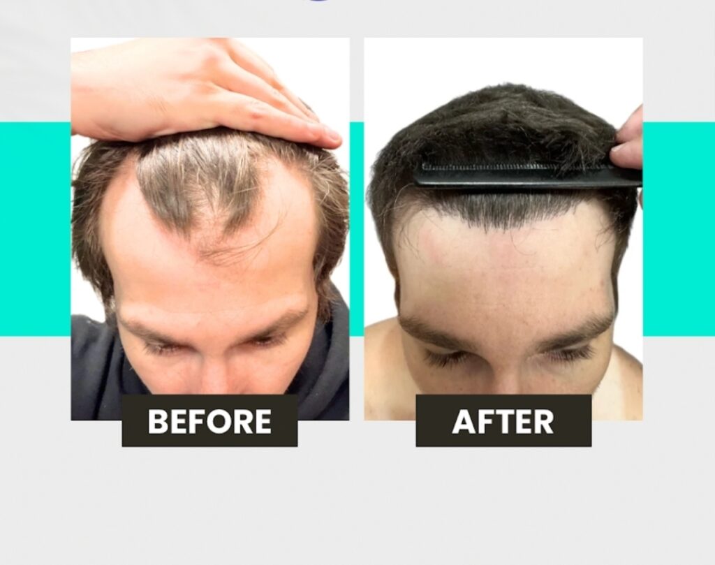 Oak Brook Hair Transplant gallery photo