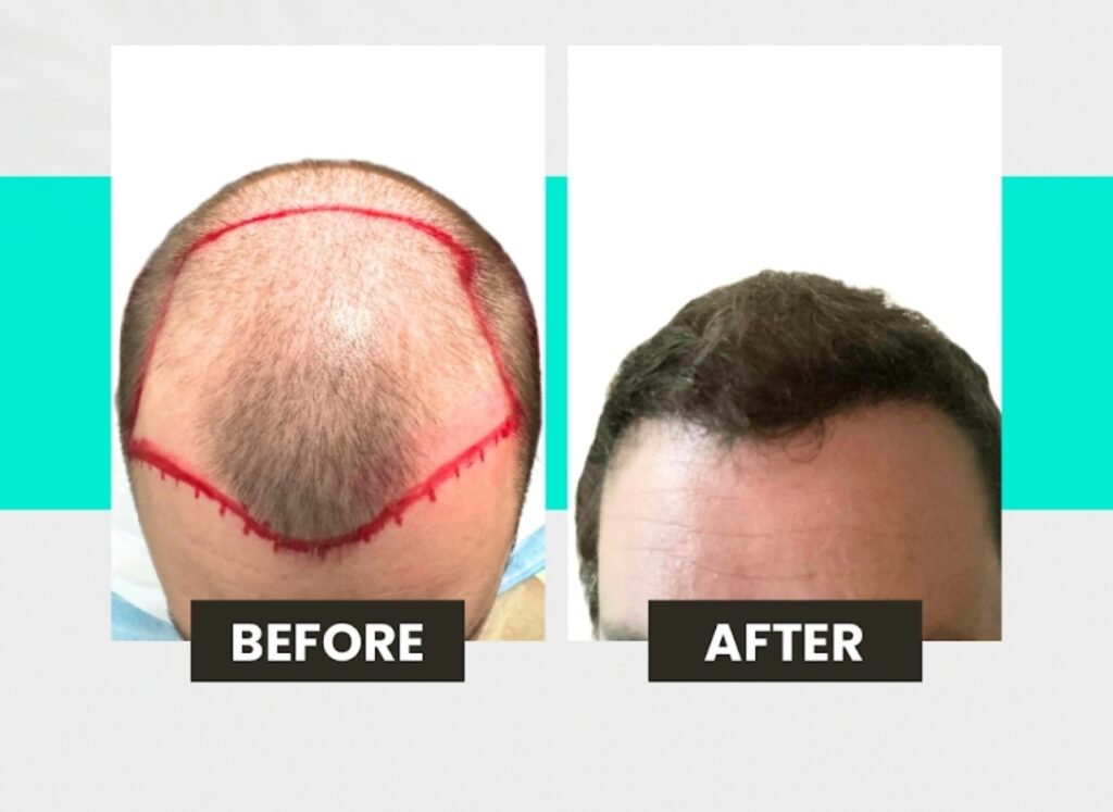 Oak Brook Hair Transplant gallery photo