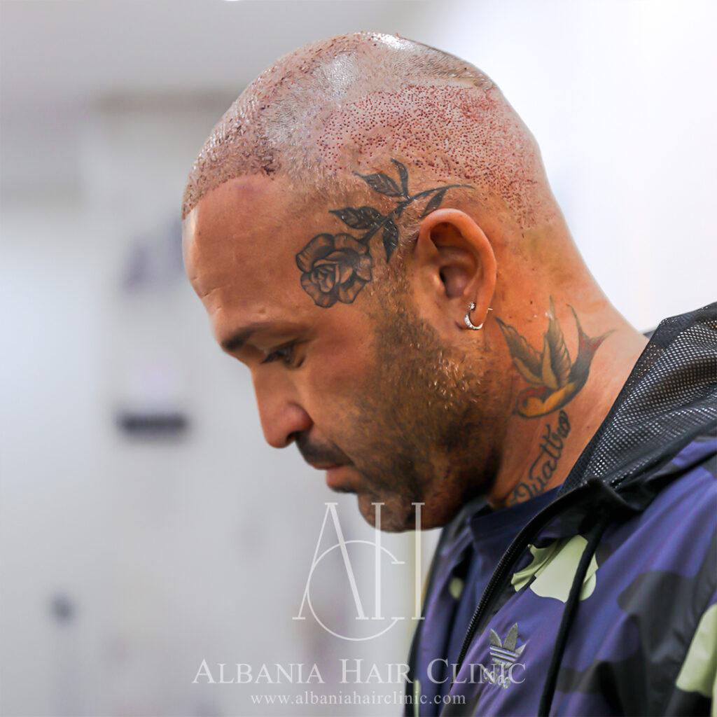Trapianto Di Capelli | Albania Hair Clinic gallery photo