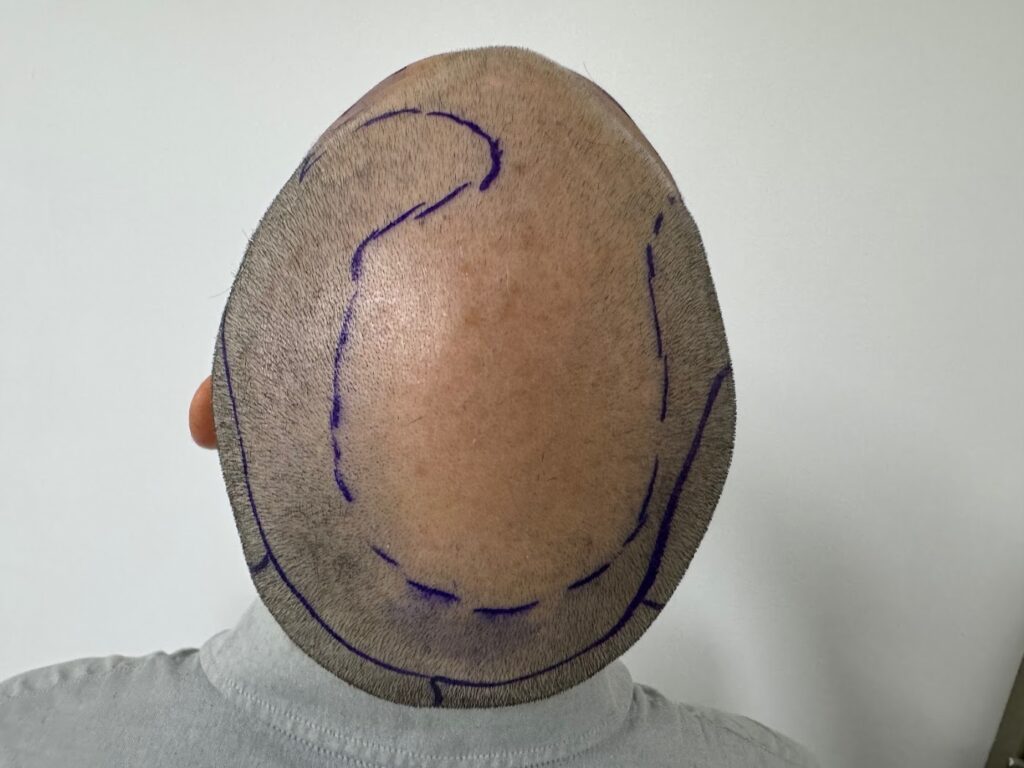 The Crown Clinic | Hair Transplant in Sydney CBD gallery photo