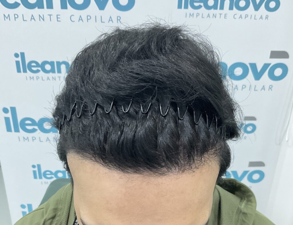 INJERTO CAPILAR ILEANOVO BOGOTÁ | IMPLANTE DE CABELLO ILEANOVO | TRASPLANTE CAPILAR ILEANOVO | INJERTO DE PELO gallery photo