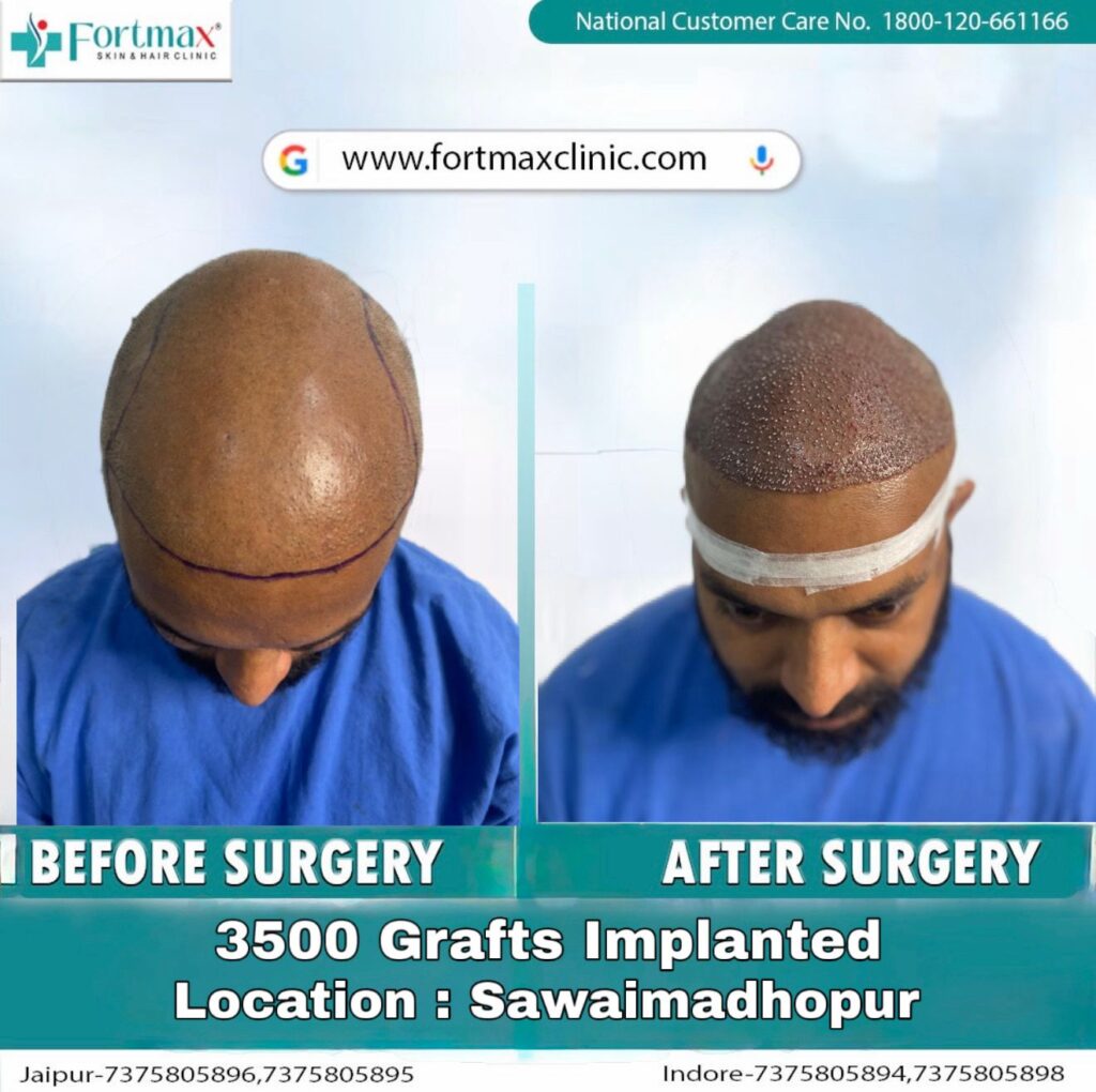 Fortmax Clinic Hair Transplant & Cosmetic Surgery in Jaipur gallery photo