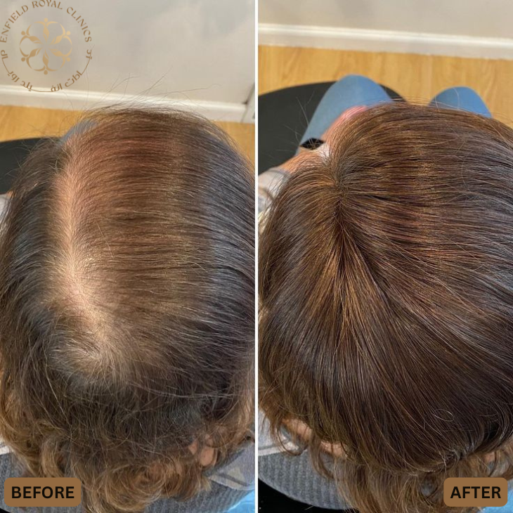 Dr Naveed Azhar – Hair Transplant in Islamabad | PRP Hair Treatment | Exosomes Therapy gallery photo