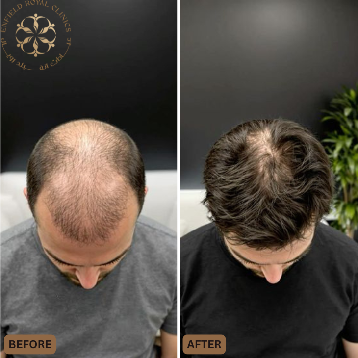 Dr Naveed Azhar – Hair Transplant in Islamabad | PRP Hair Treatment | Exosomes Therapy gallery photo