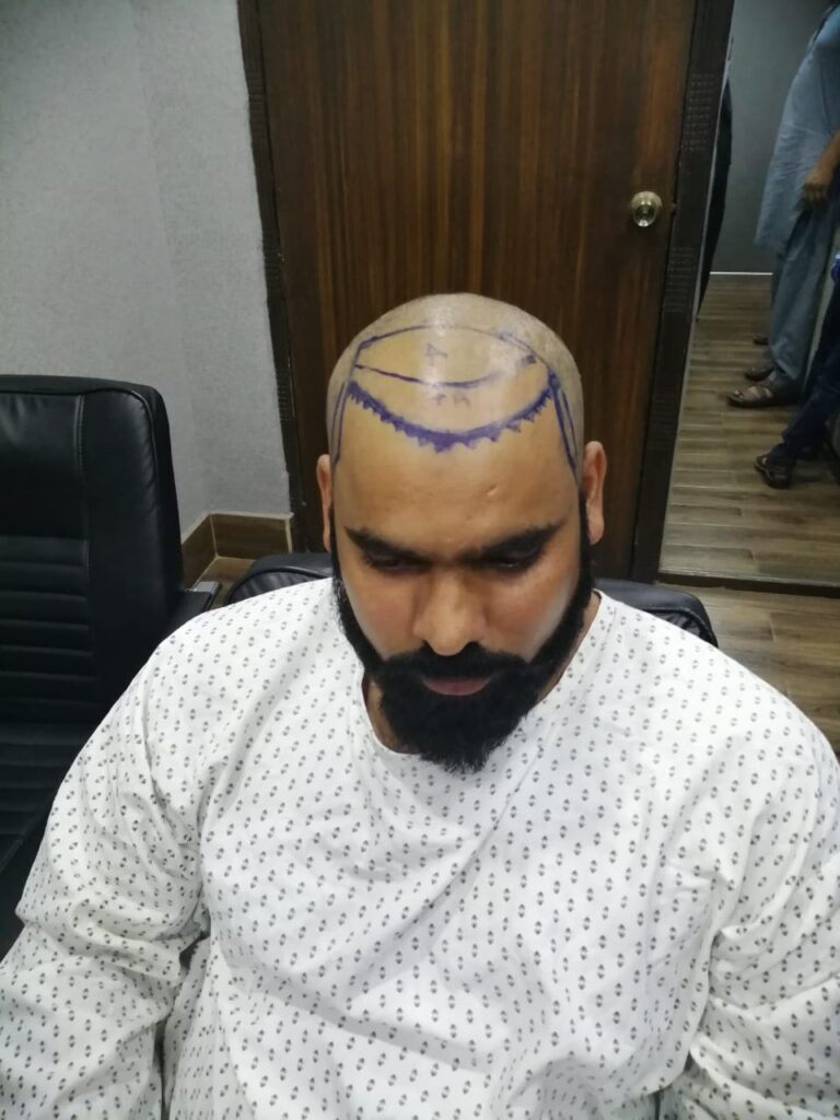 Hair Zone Care Center – Hair Replacement & Hair Transplant Lahore gallery photo