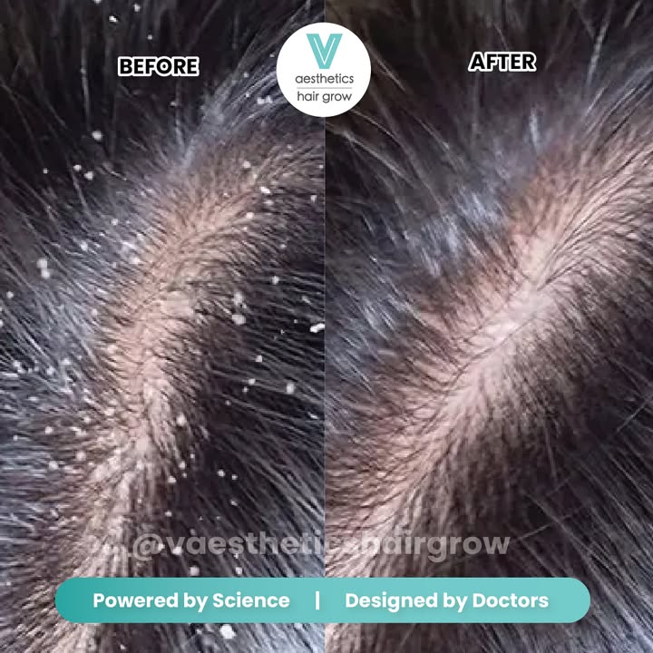 V Aesthetics Hair Grow (Novena) | Singapore Hair Loss Treatments gallery photo