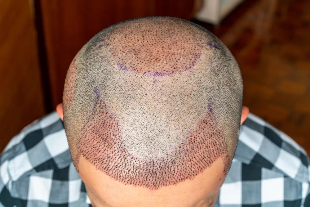Ultra Hair Clinic gallery photo