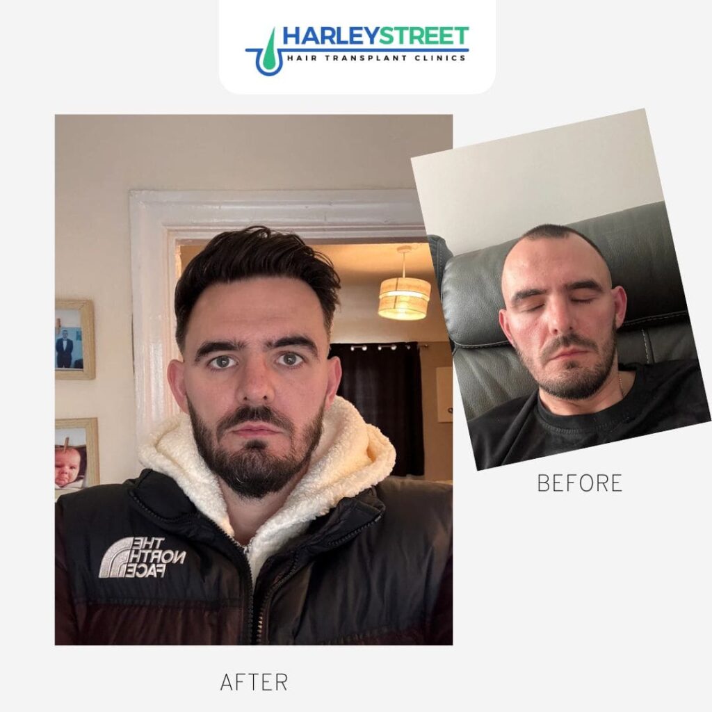 Hair Transplant Nottingham gallery photo