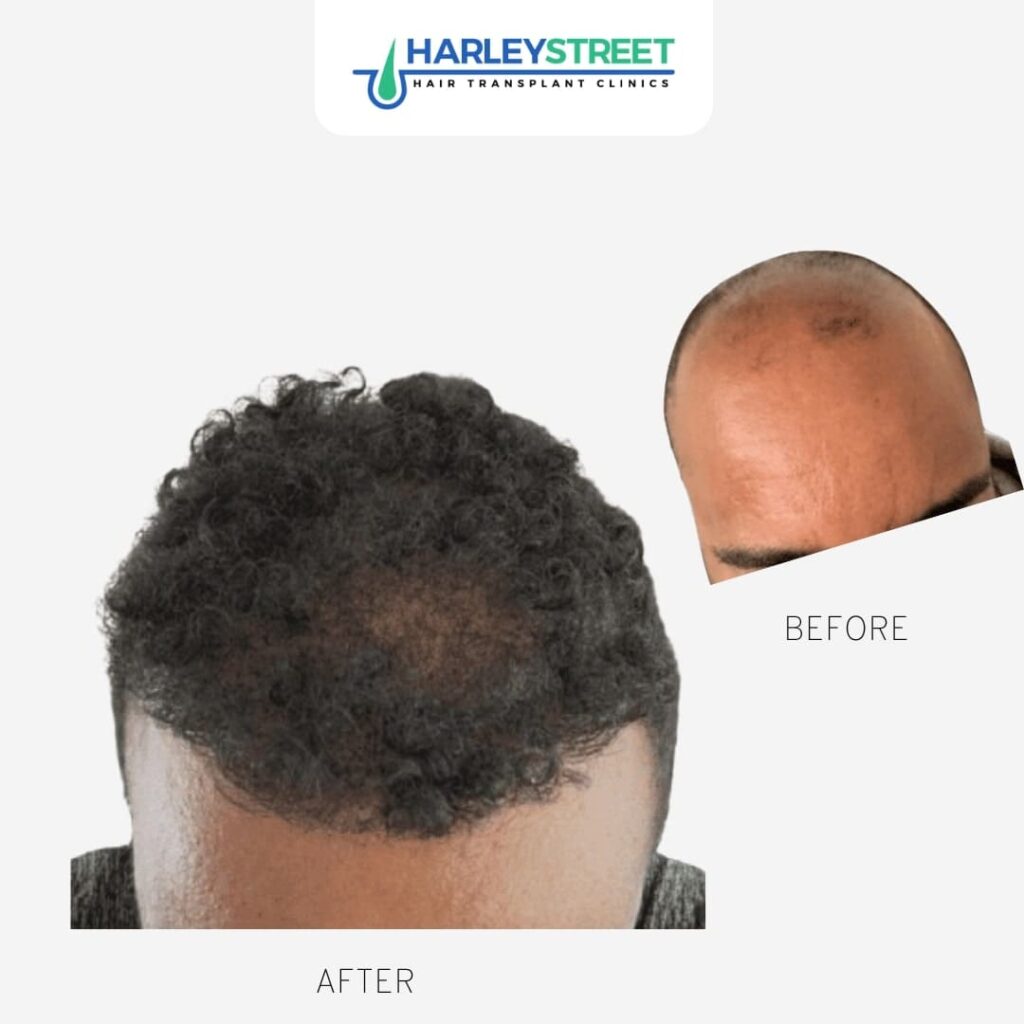 Hair Transplant Nottingham gallery photo