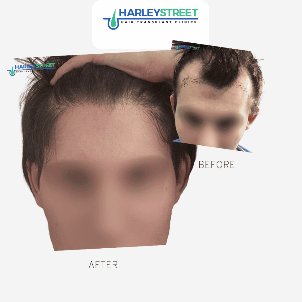 Hair Transplant Nottingham gallery photo