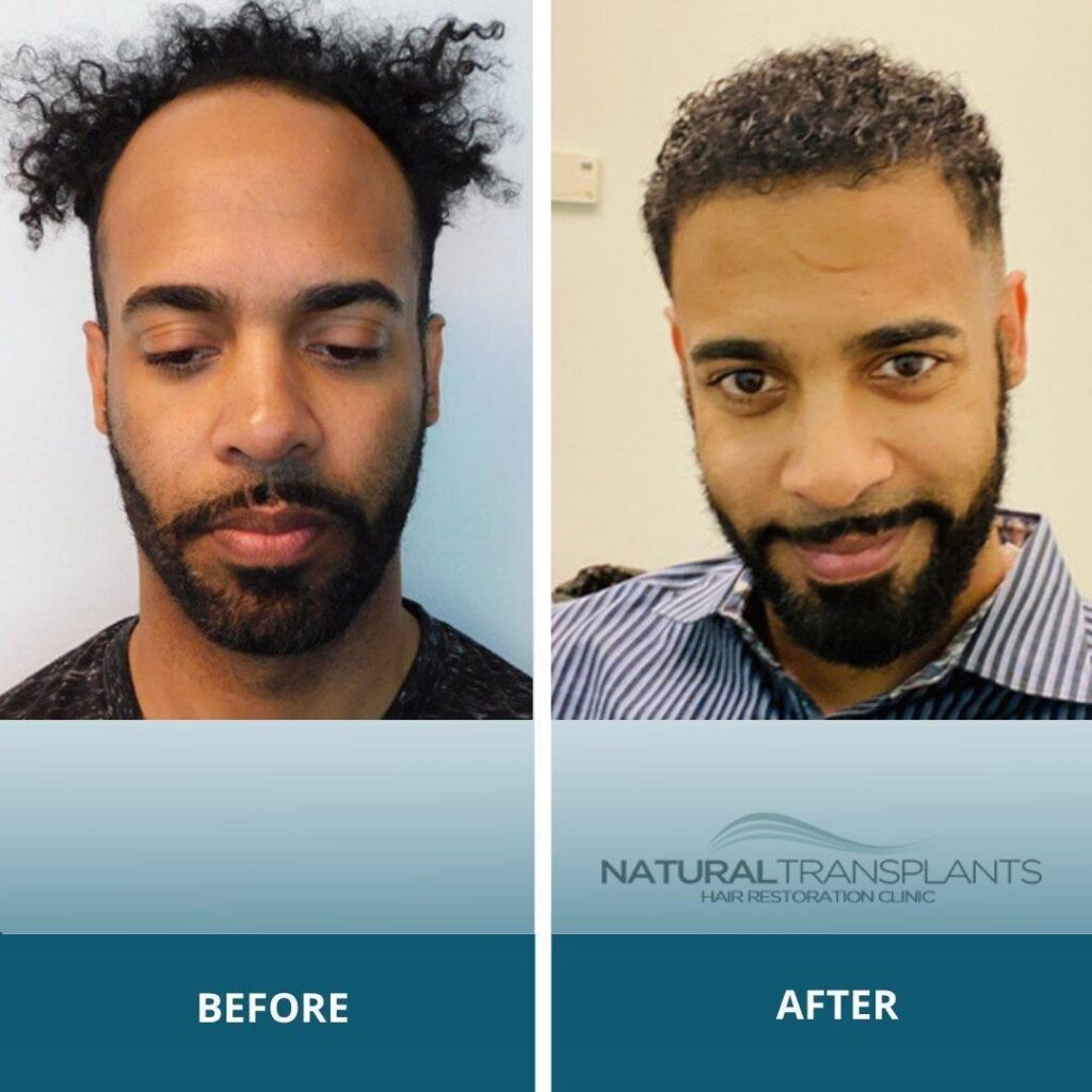 Natural Transplants, Hair Restoration Clinic gallery photo