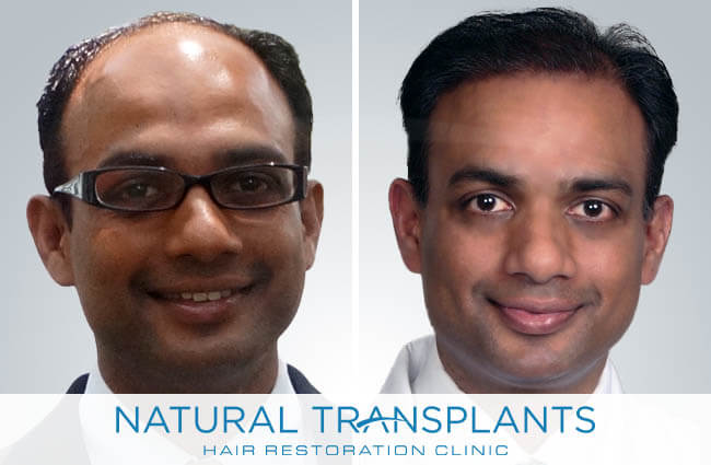 Natural Transplants, Hair Restoration Clinic gallery photo