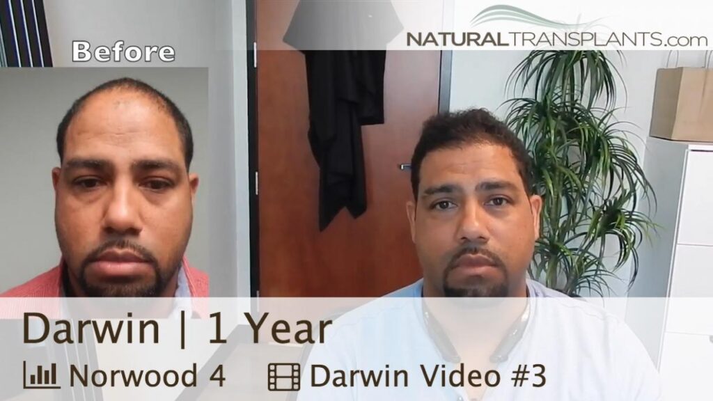 Natural Transplants, Hair Restoration Clinic gallery photo
