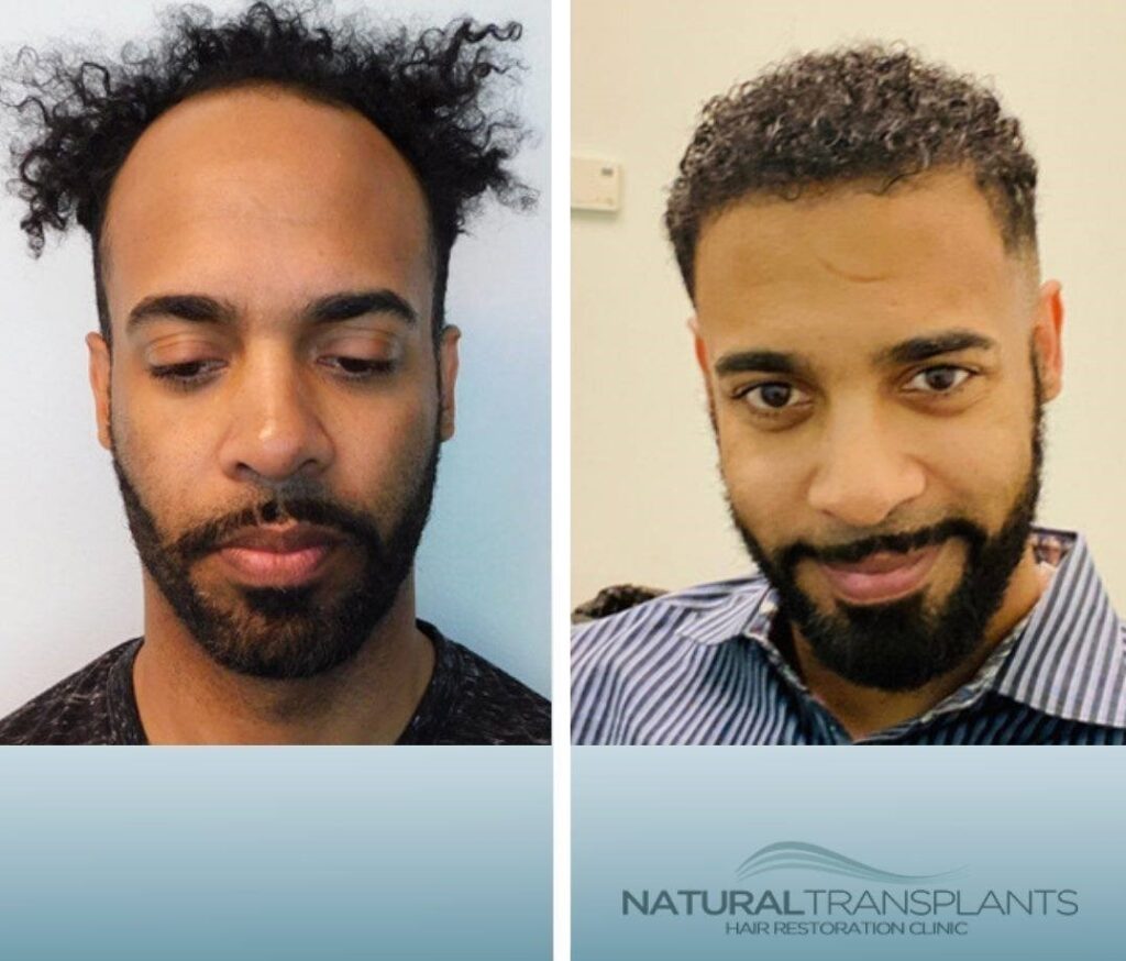 Natural Transplants, Hair Restoration Clinic gallery photo