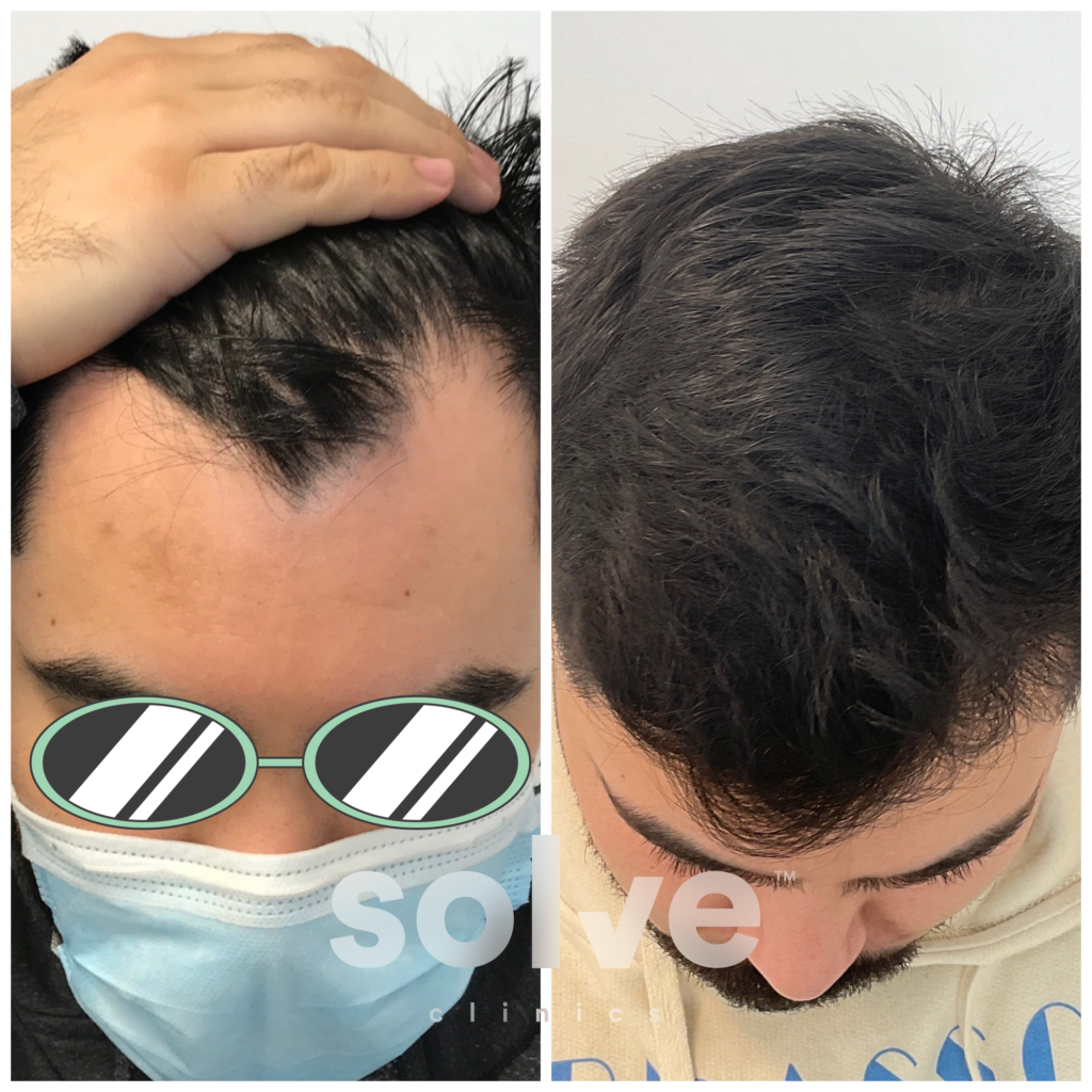 Hair Transplant Chicago from Solve gallery photo