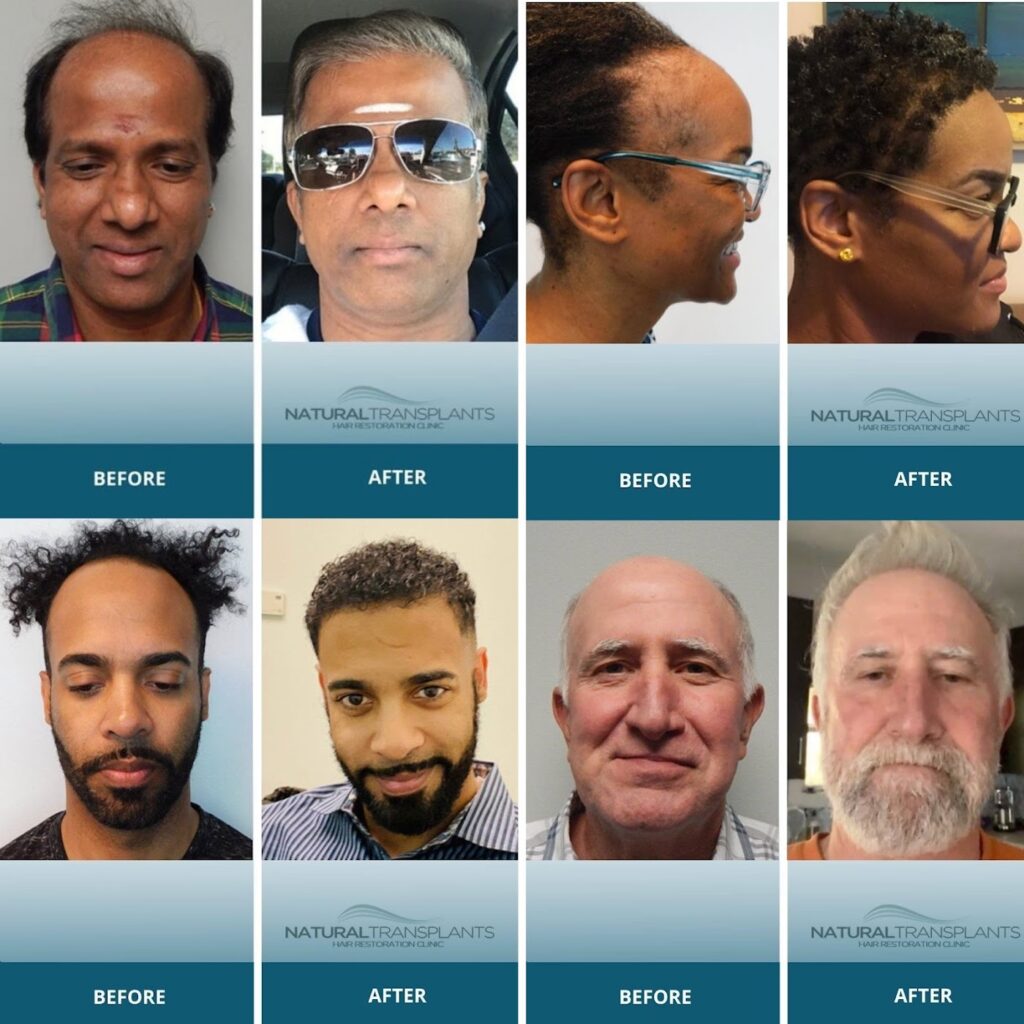 Natural Transplants, Hair Restoration Clinic gallery photo