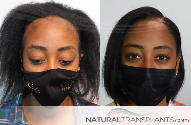 Natural Transplants, Hair Restoration Clinic gallery photo