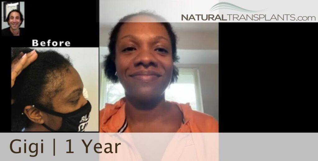Natural Transplants, Hair Restoration Clinic gallery photo