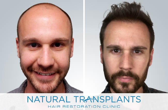 Natural Transplants, Hair Restoration Clinic gallery photo