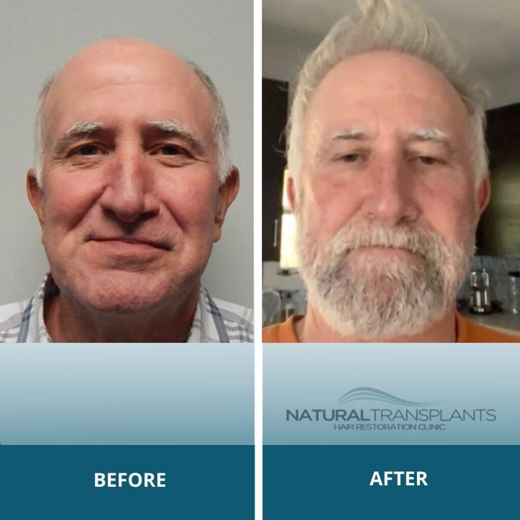 Natural Transplants, Hair Restoration Clinic gallery photo