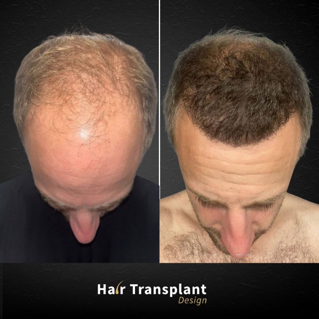 Hair Transplant Design gallery photo