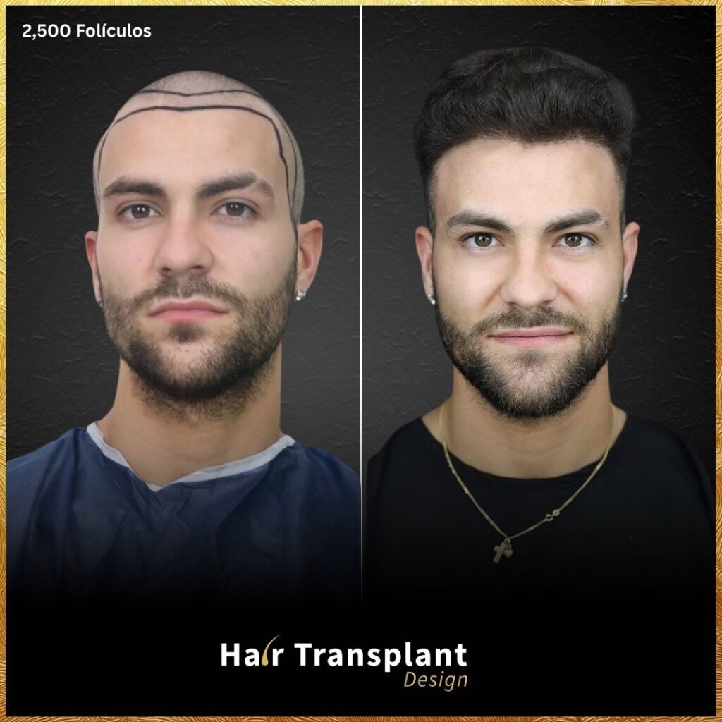 Hair Transplant Design gallery photo