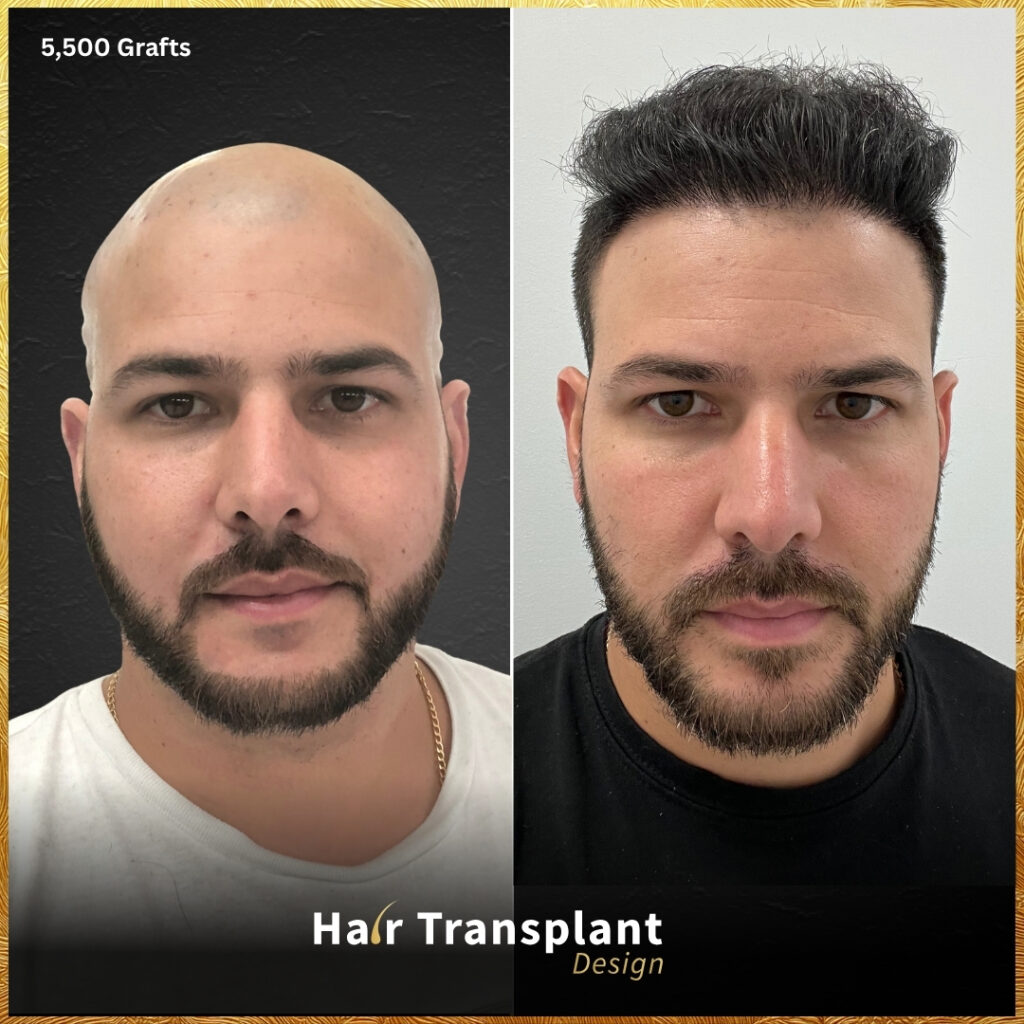Hair Transplant Design gallery photo