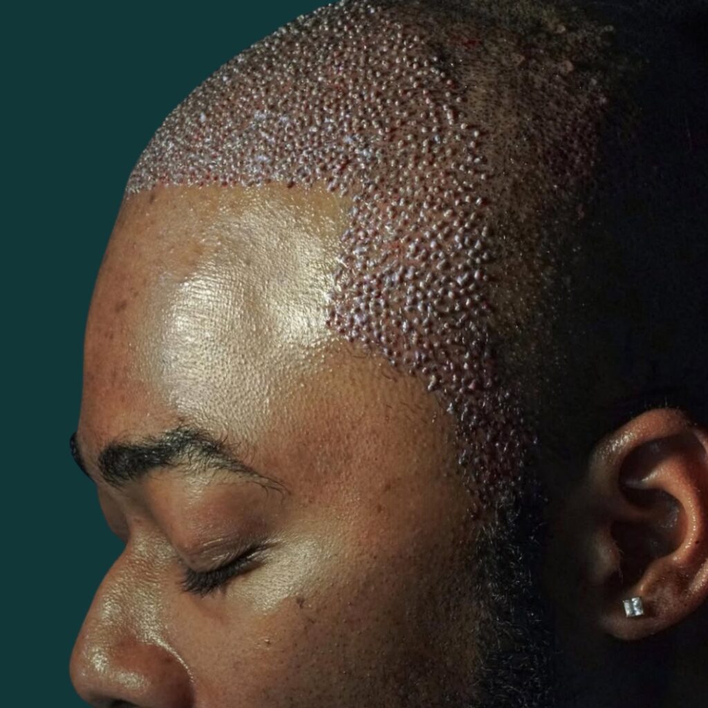 Hair Transplant Design gallery photo