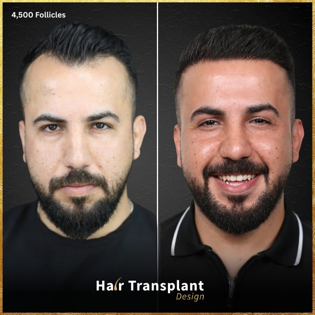 Hair Transplant Design gallery photo
