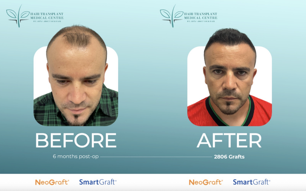 Hair Transplant Medical Centre Mississauga & Toronto | Hair Loss Treatment gallery photo